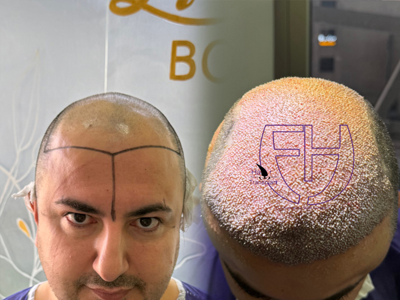 کاشت مو به روش fit و sut