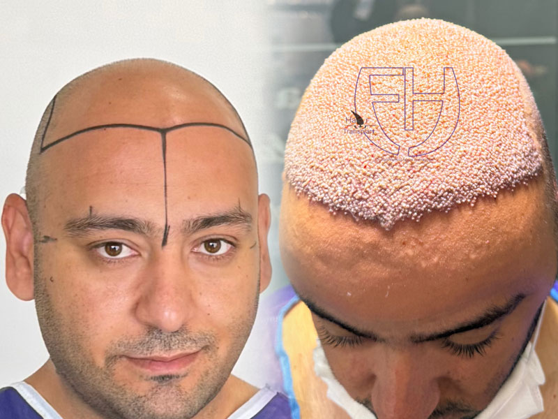 کاشت مو به روش fit