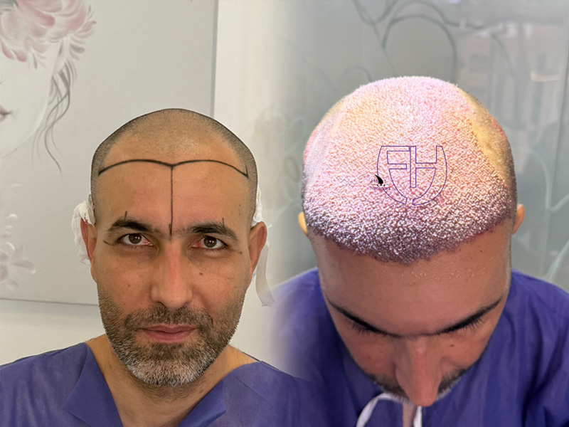 کاشت مو به روش fit و sut