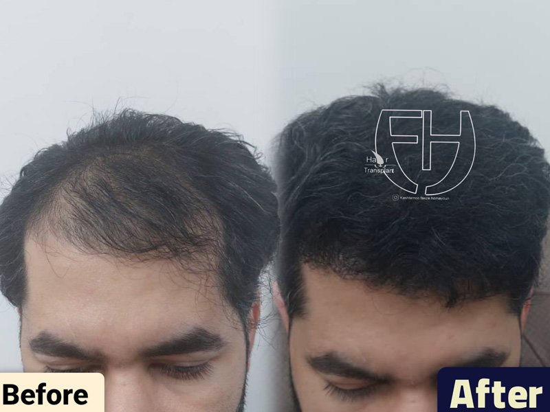 کاشت مو به روش fit