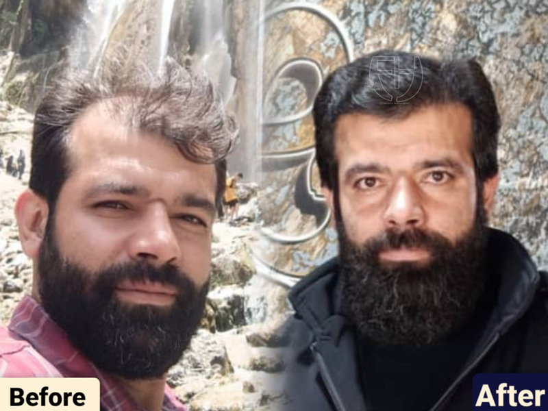 کاشت مو به روش fit و sut