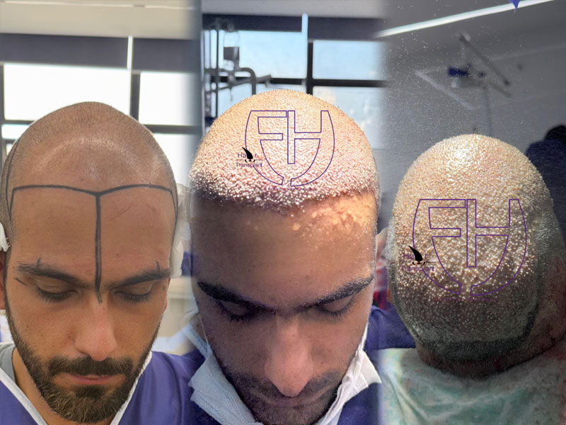 کاشت مو به روش fit و sut