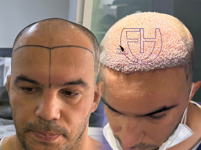 کاشت مو به روش fit و sut