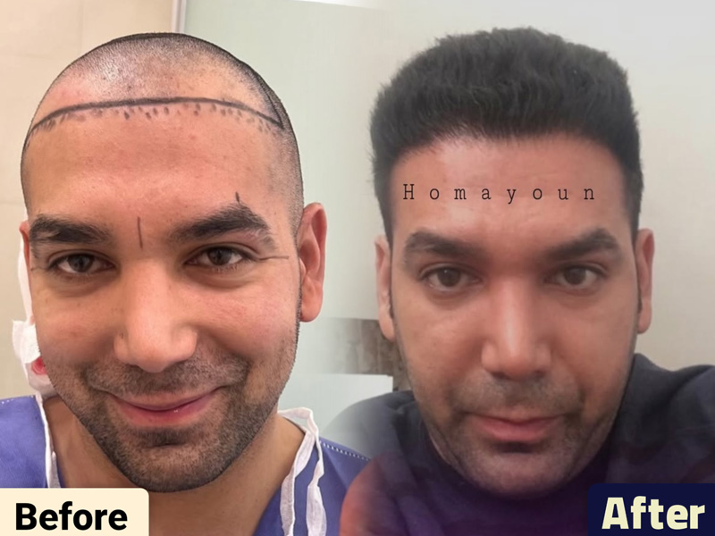 کاشت مو به روش fit