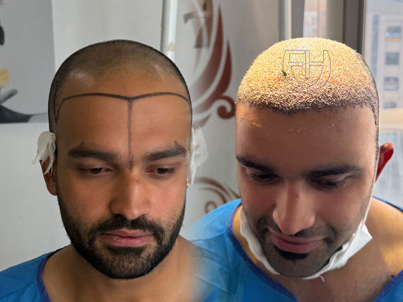 کاشت مو به روش fit