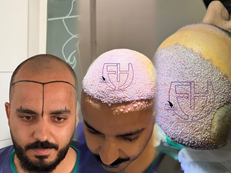 کاشت مو به روش fit