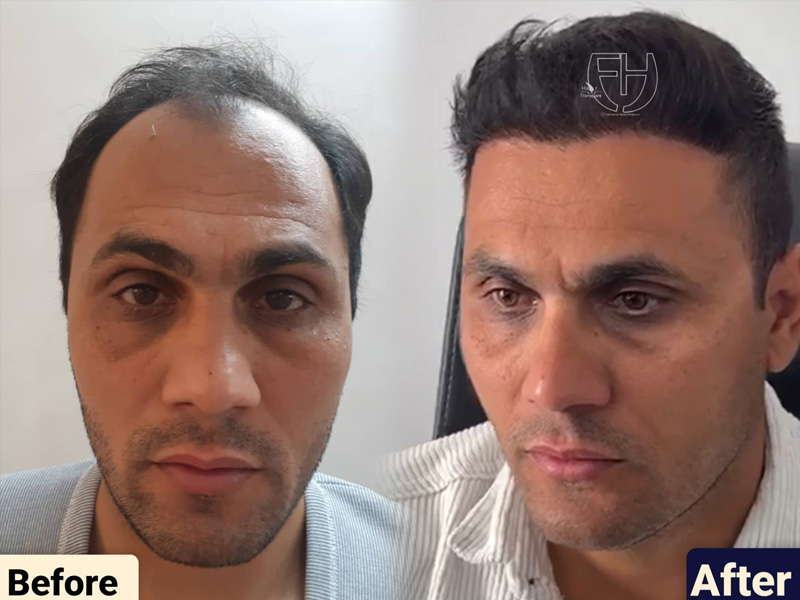 کاشت مو به روش fit و sut