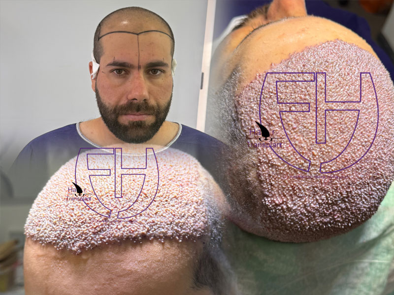 کاشت مو به روش fit