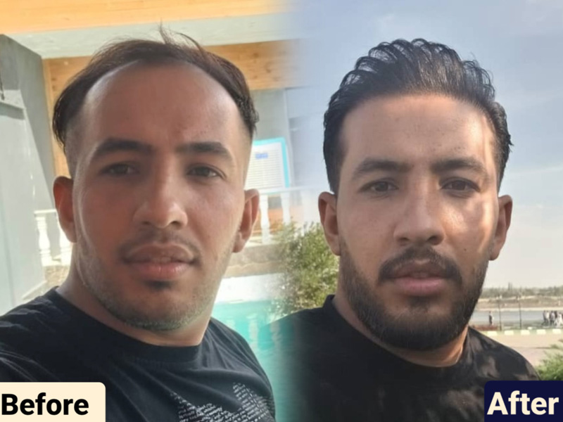 کاشت مو به روش fit و sut