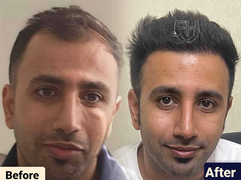 کاشت مو به روش fit