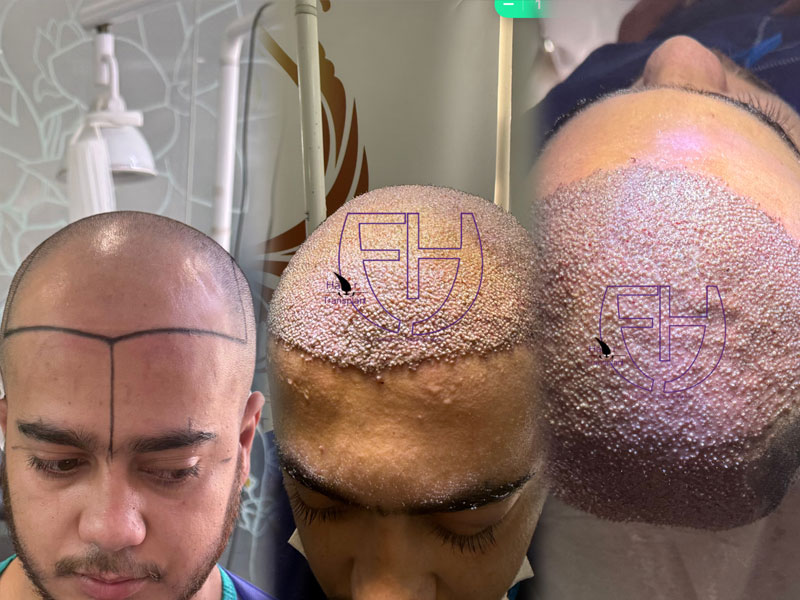 کاشت مو به روش fit