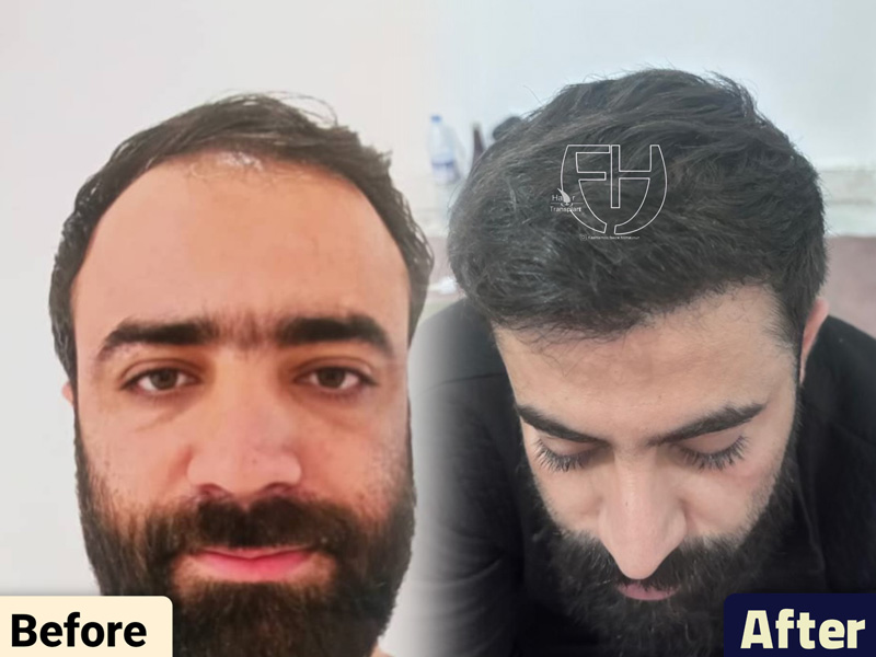کاشت مو به روش fit