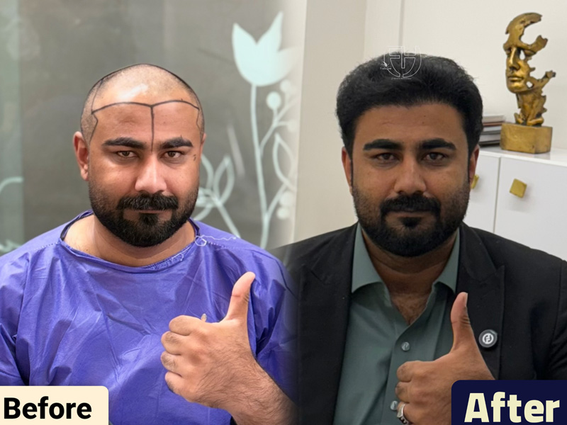 کاشت مو به روش fit