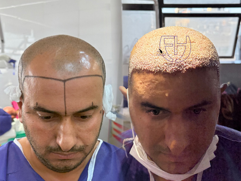 کاشت مو به روش fit و sut