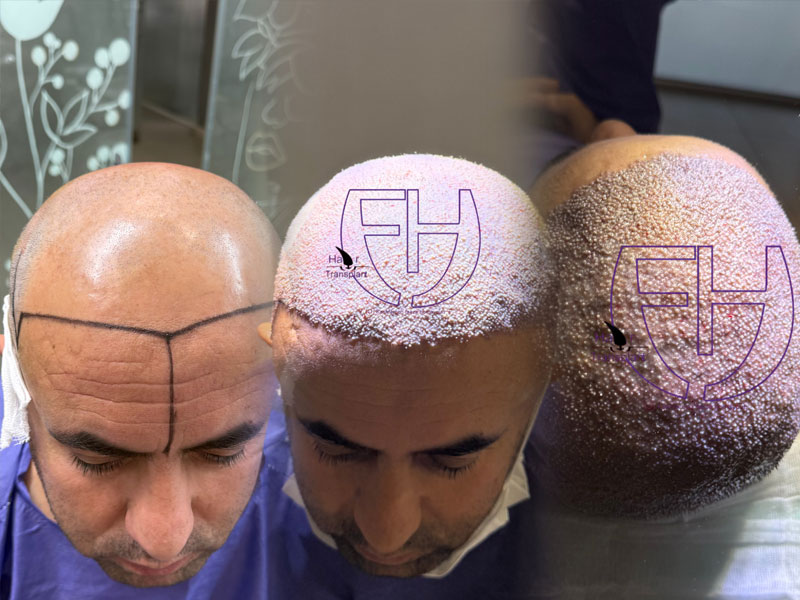 کاشت مو به روش fit