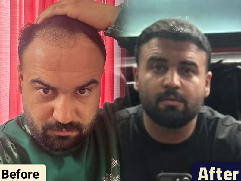 کاشت مو به روش fit