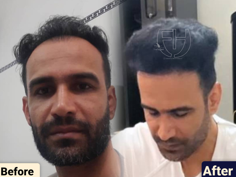 کاشت مو به روش fit و sut
