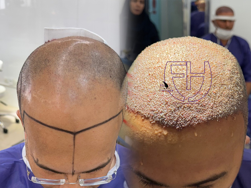 کاشت مو به روش fit