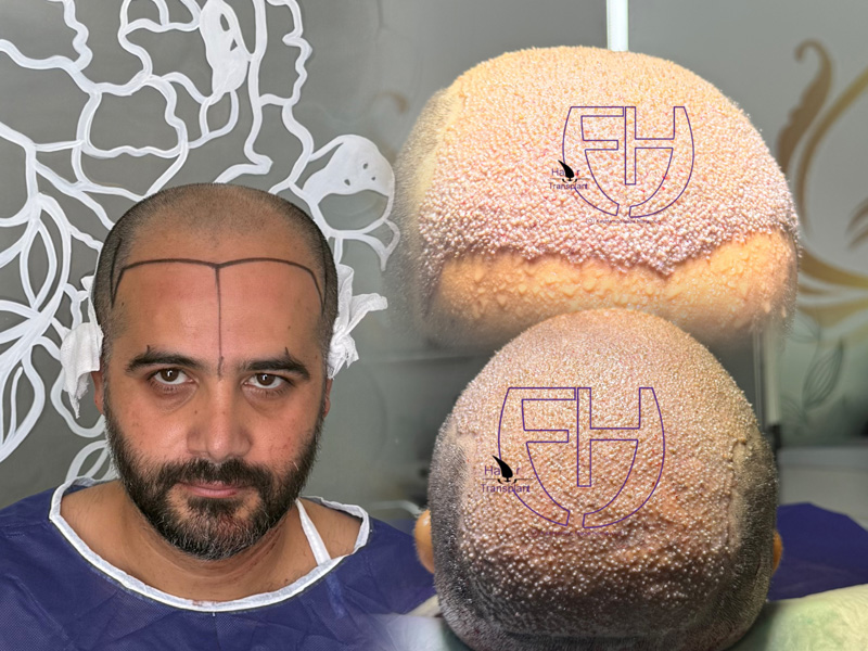 کاشت مو به روش fit