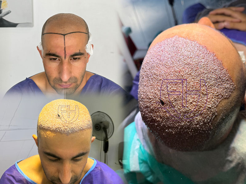 کاشت مو به روش fit