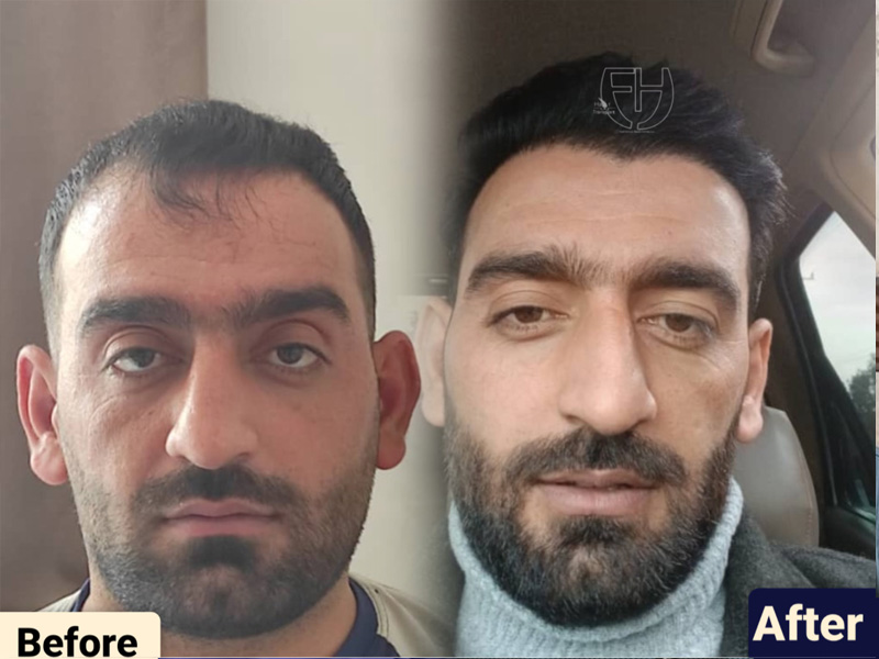 کاشت مو به روش fit