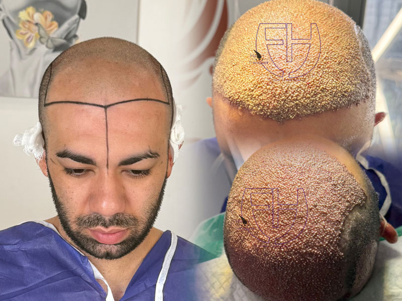 کاشت مو به روش fit و sut