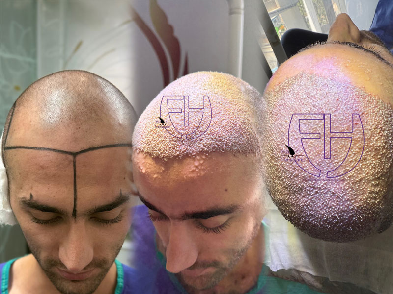 کاشت مو به روش fit و sut