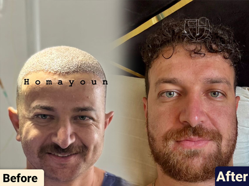 کاشت مو به روش fit و sut