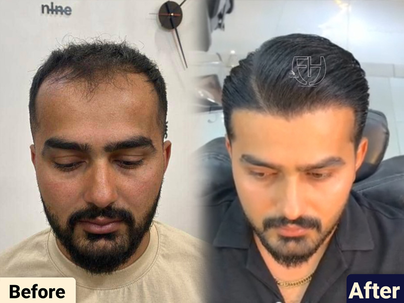 کاشت مو به روش fit و sut