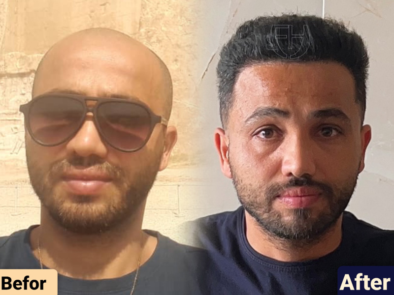 کاشت مو به روش fit