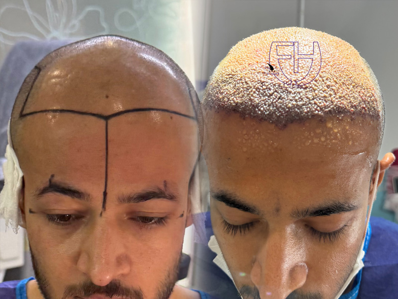 کاشت مو به روش fit