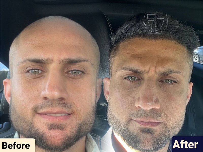 کاشت مو به روش fit