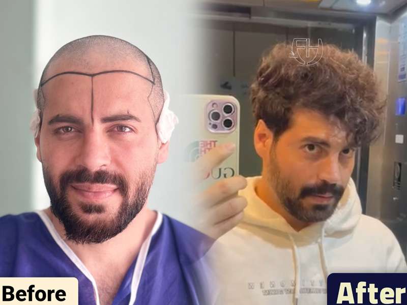 کاشت مو به روش fit و sut