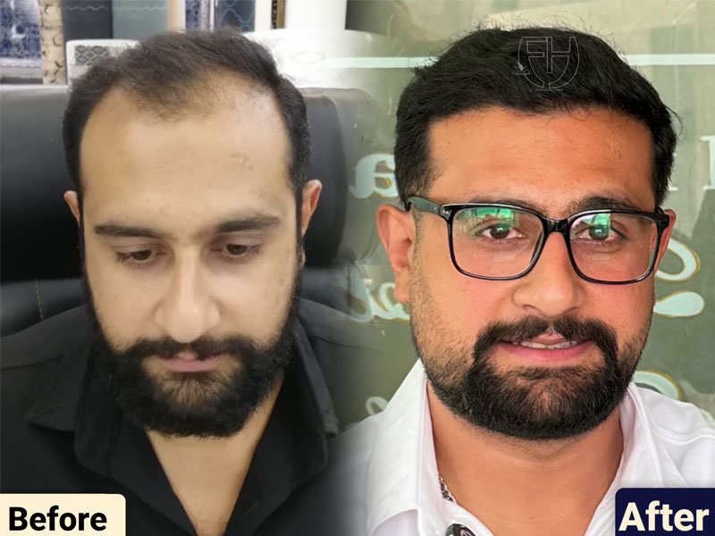 کاشت مو به روش fit و sut