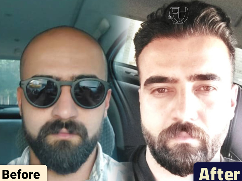 کاشت مو به روش fit و sut