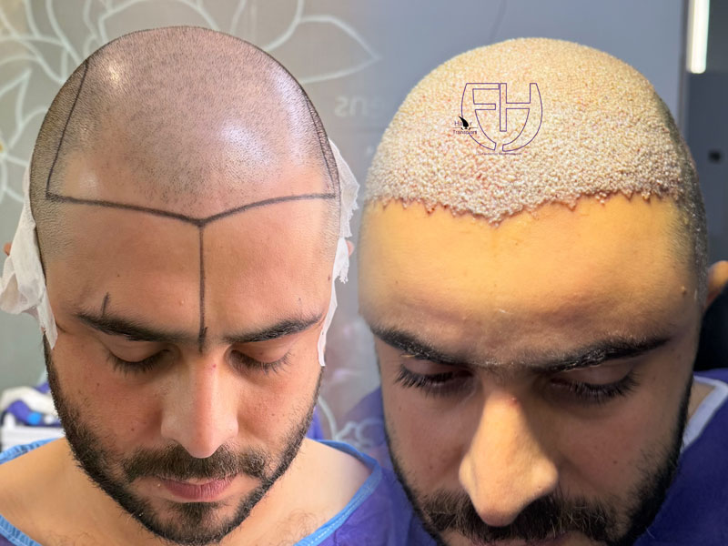 کاشت مو به روش fit