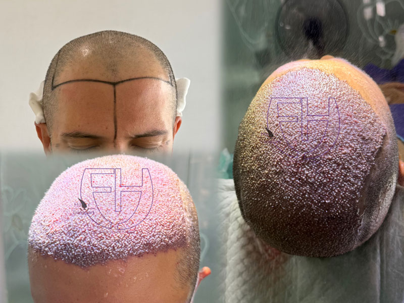 کاشت مو به روش fit