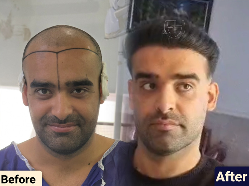 کاشت مو به روش fit