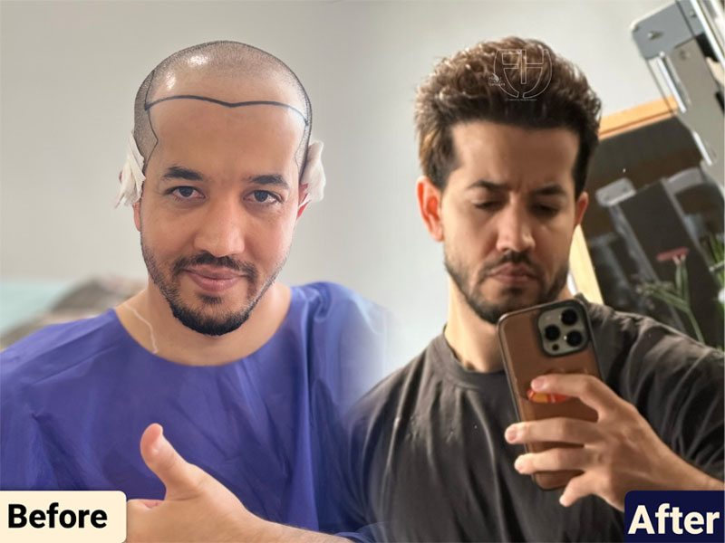 کاشت مو به روش fit و sut