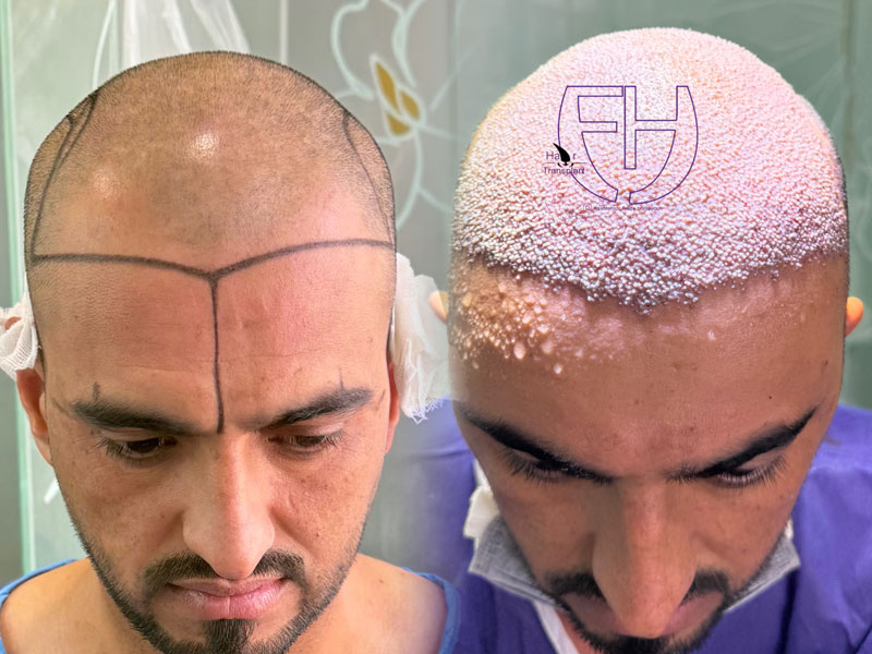 کاشت مو به روش fit