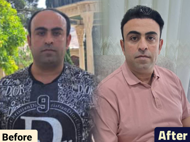 کاشت مو به روش fit و sut