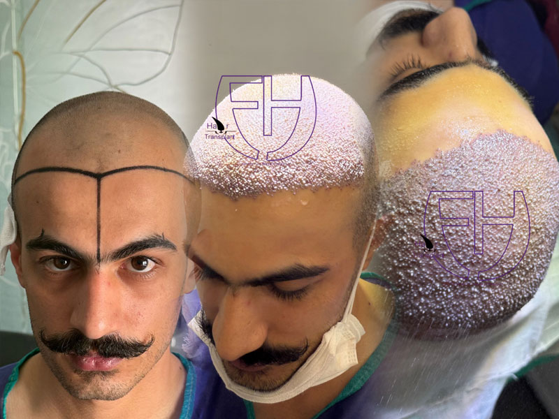 کاشت مو به روش fit