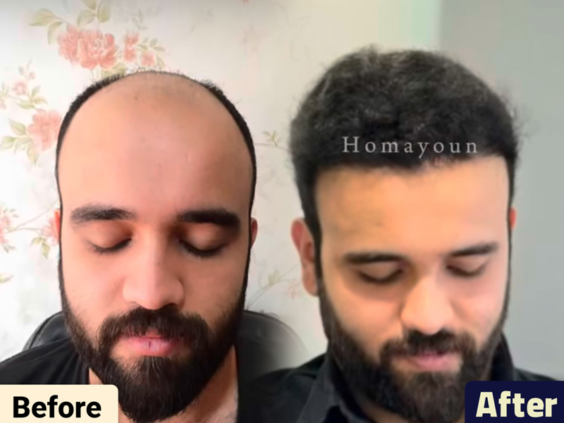 کاشت مو به روش fit و sut
