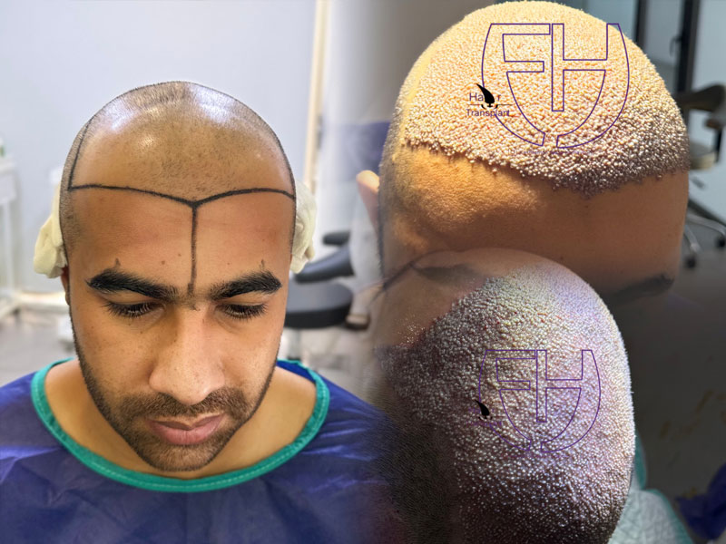 کاشت مو به روش fit