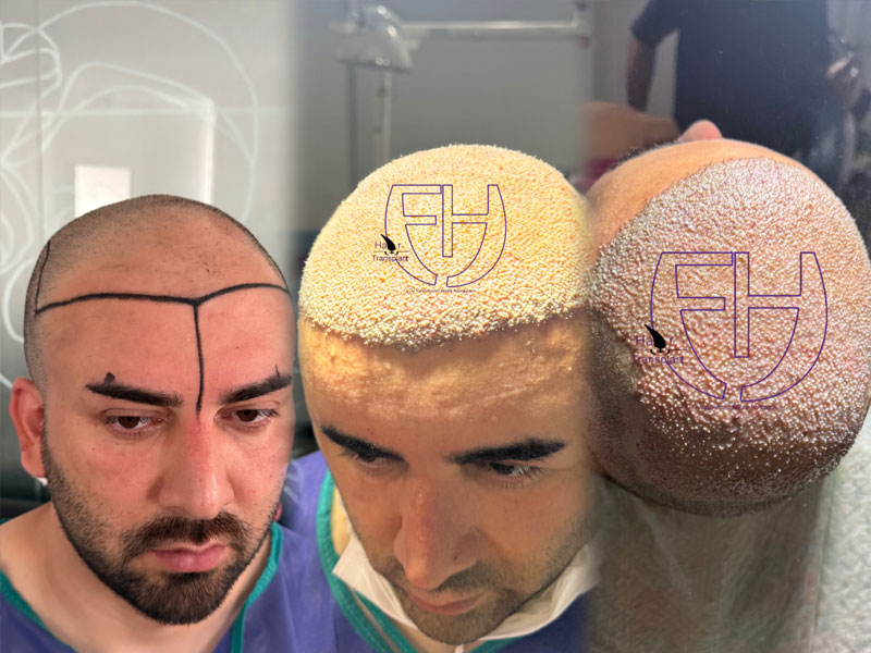 کاشت مو به روش fit و sut