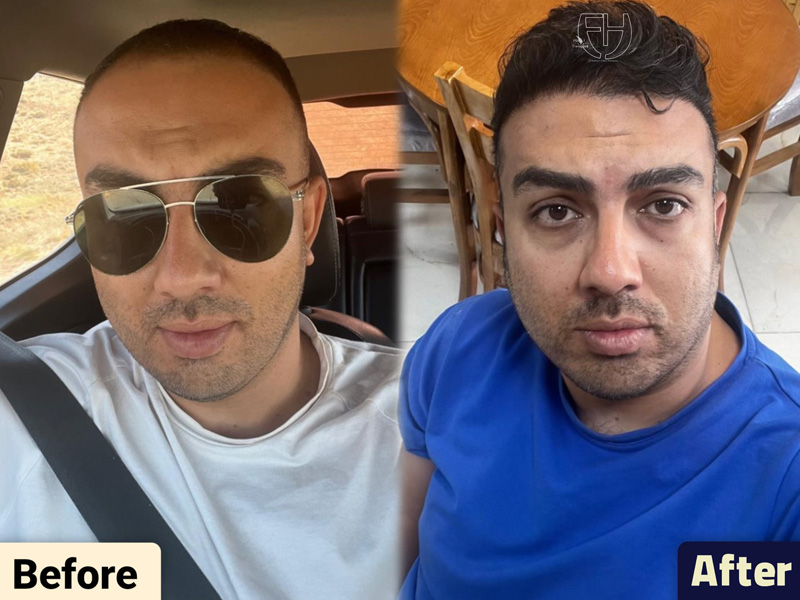کاشت مو به روش fit