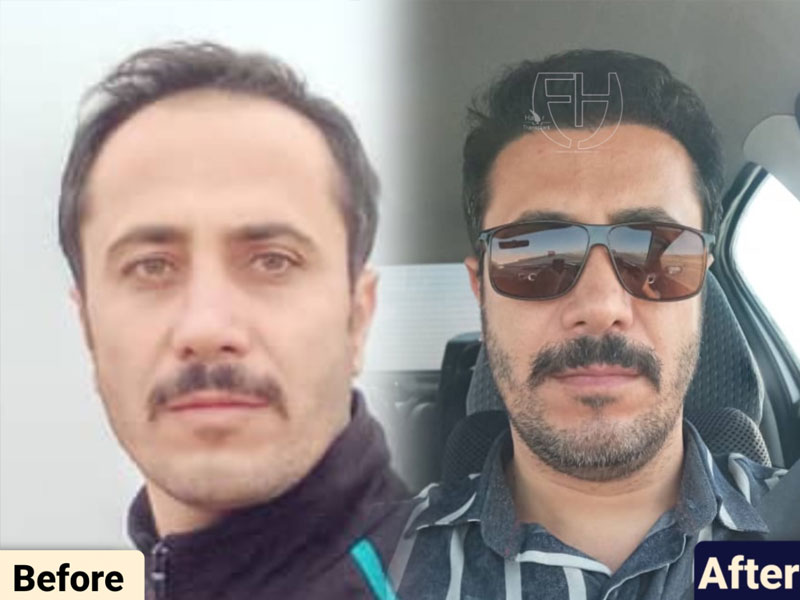 کاشت مو به روش fit