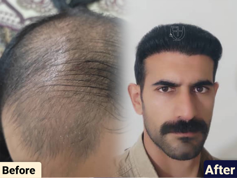 کاشت مو به روش fit و sut