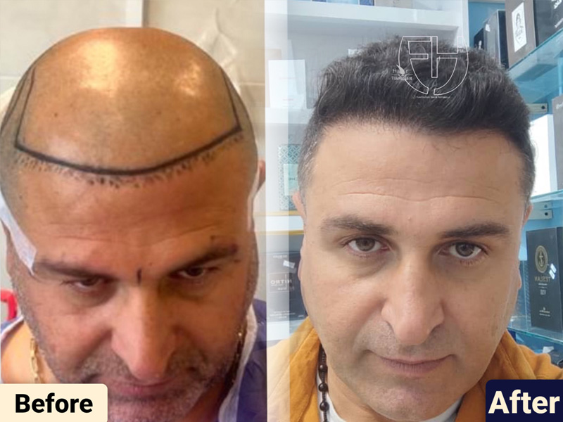 کاشت مو به روش fit