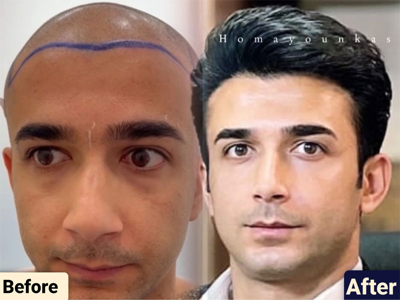 کاشت مو به روش fit و sut
